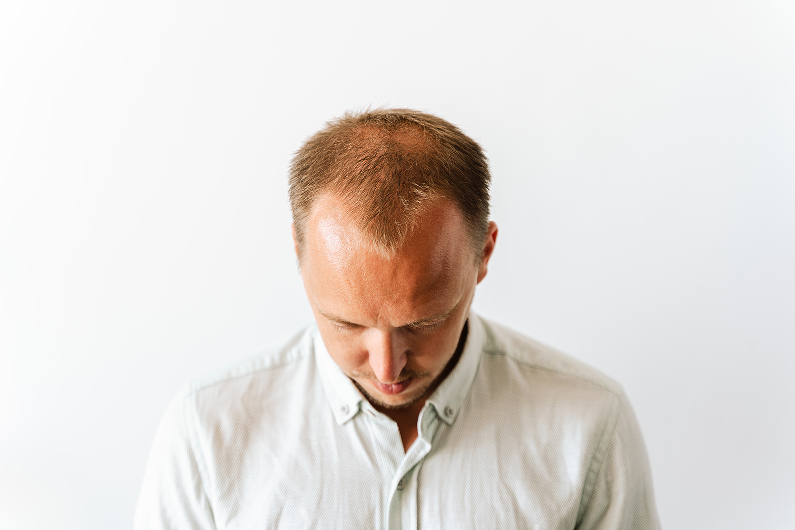 Hair Restoration: A holistic approach to solving your hair loss