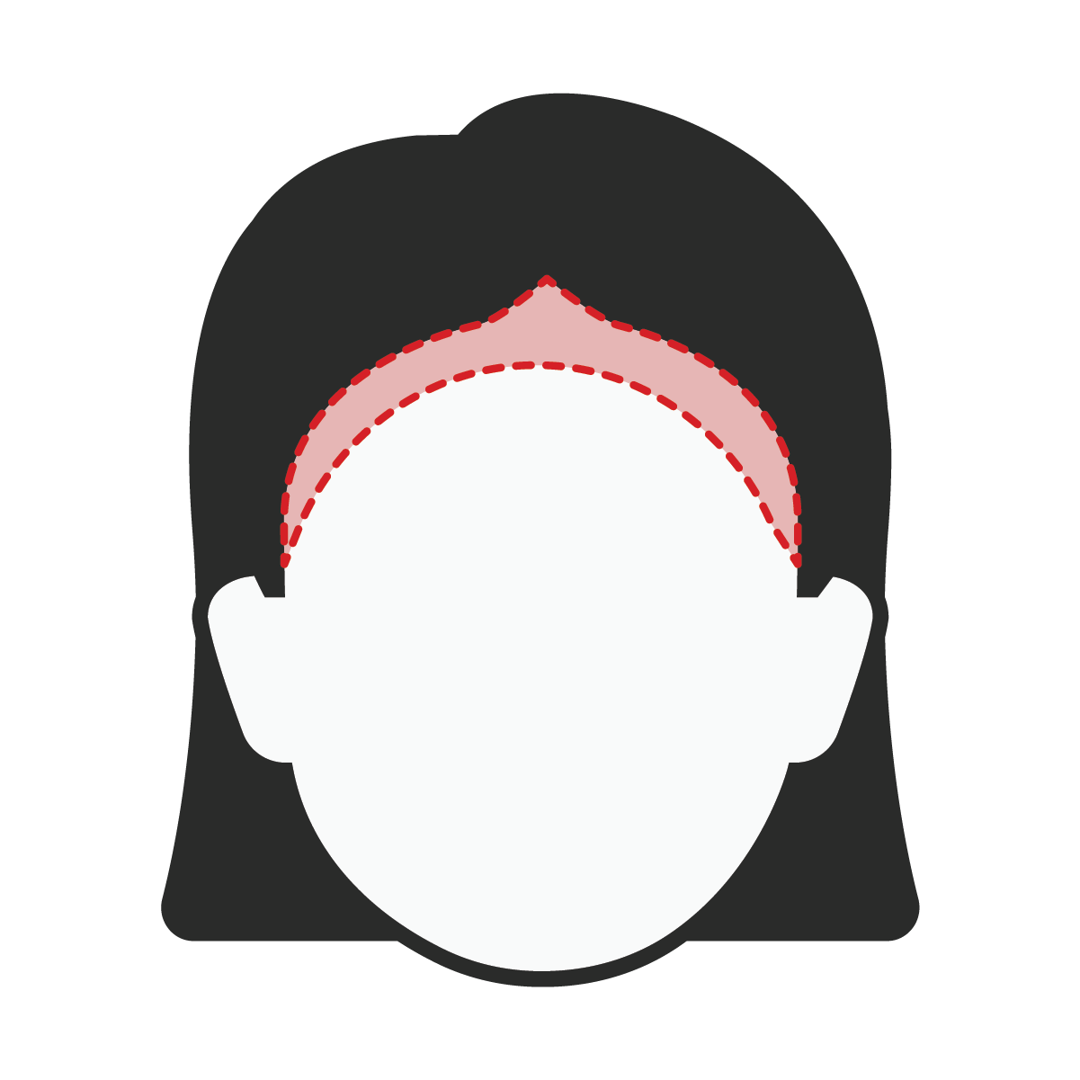 Hairline Restoration