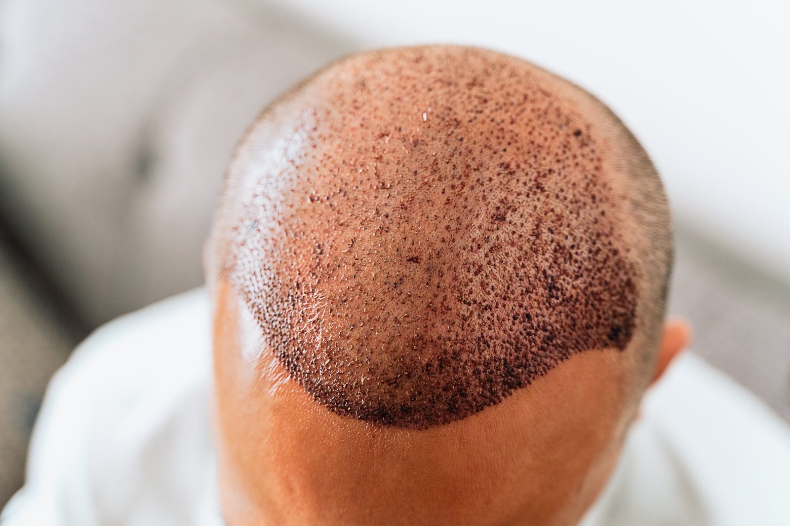 Get Your Hair Back with SmartGraft FUE Hair Transplant