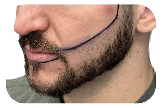 Beard before transformation Beard before transformation