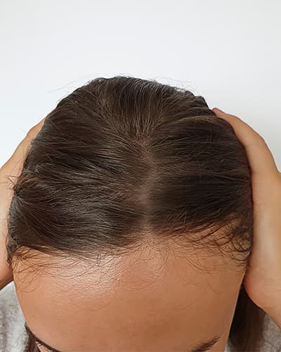 Scalp after transformation Scalp after transformation