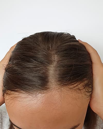 Scalp before transformation Scalp before transformation