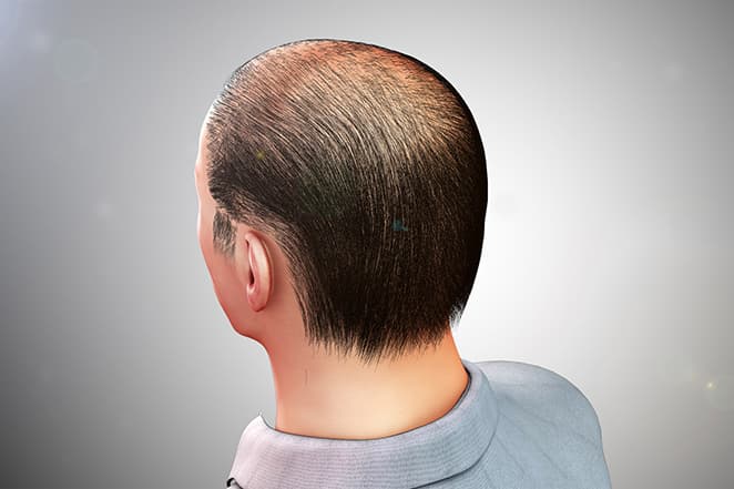 Hair Loss Regenerative Solution Hair Loss Regenerative Solution