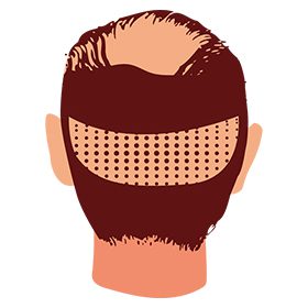 SmartGraft® Hair Restoration