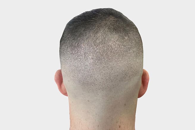Hair transplant final result