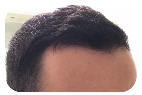 Scalp after transformation Scalp after transformation