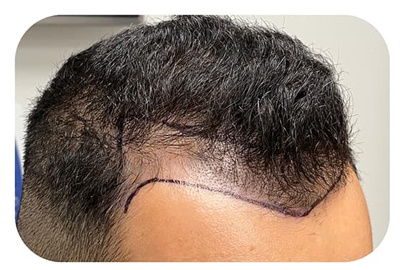 Scalp before transformation Scalp before transformation