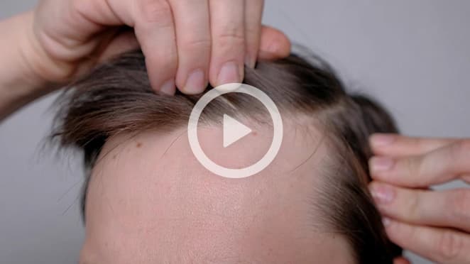 Hyperbaric oxygen therapy