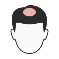 Crown restoration for men