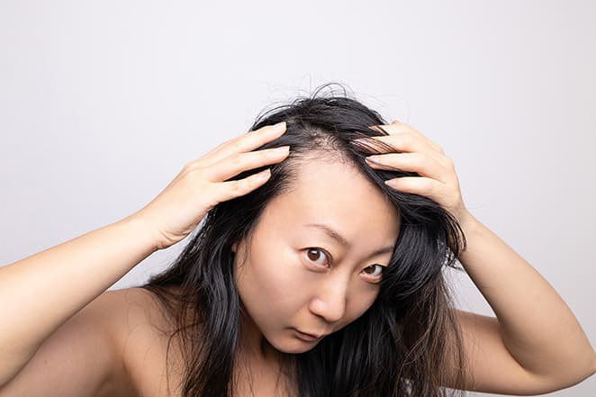 Hair loss in women