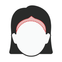 Hairline restoration for women