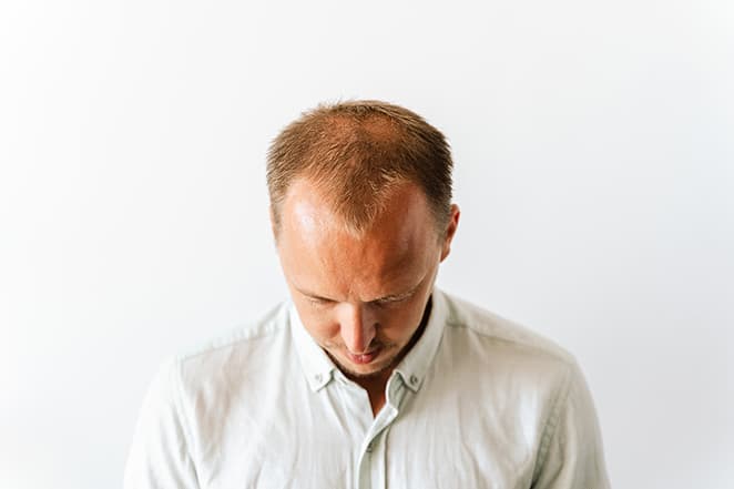 Male pattern hair loss