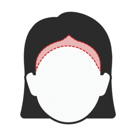 Transgender Feminization Hairline