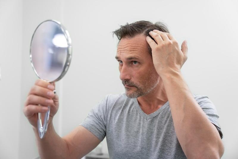 The First Year: What to Expect After Your Hair Transplant