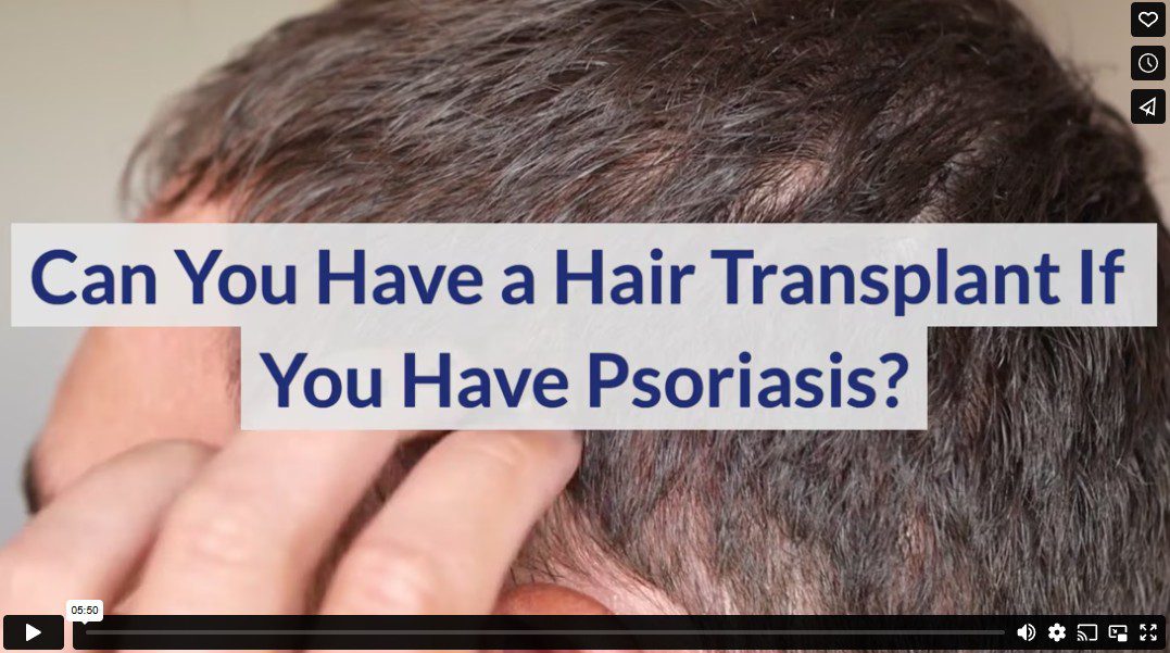 Can You Have a Hair Transplant If You Have Psoriasis?